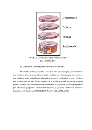 15

Degeneração

Protusa

Extrusa

Seqüestrada

FIGURA 3 Mostra complicações no núcleo pulposo.
Fonte: (ASSIS, 2011)
2.2 ANATOMIA E COMPOSIÇÃO DO DISCO INTERVERTEBRAL
As vértebras estão ligadas entre si por dois tipos de articulações, discovertebrais e
interpofisárias. Discovertebrais são articulações cartilaginosas formadas por corpos e discos
intervertebrais, sendo especialmente adaptadas a amortecer e redistribuir o peso. Os discos
são formados por um anel fibroso na periferia, e na porção central encontra-se o núcleo
pulposo, macio e com textura gelatinosa como vemos na (Figura 4). Possui duplo propósito
para articulação, que permitir a flexibilidade da coluna, e agir como amortecedor, prevenindo
traumatismo e lesões ósseas (KHALE, LEONHARDT e PLATZER, 2000).

 