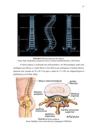 17

FIGURA 5 Mostra espessura dos discos.
Fonte: http://pt.photaki.com/picture-raios-x-coluna-vertebral-humana_150122.htm
O núcleo pulposo é constituído por polissacarídeos e de fibrocartilagem sendo mais
cartilagíneo que fibroso, e o anulo fibroso é mais fibroso que cartilaginoso e bastante elástico,
apresenta uma variação de 70 a 90 % de água e média de 15 a 20% de colágeno(Figura 6)
(DÂNGELO e FATTINI, 2002).

FIGURA 6 Núcleo pulposo
Fonte: httphttp://www.umm.edu/esp_imagepages/19469.htm

 