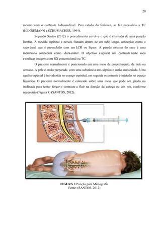 20

mesmo com o contraste hidrossolúvel. Para estudo do forâmen, se faz necessária a TC
(HENNEMANN e SCHUMACHER, 1994).
Segundo Santos (2012) o procedimento envolve o que é chamado de uma punção
lombar. A medula espinhal e nervos flutuam dentro de um tubo longo, conhecido como o
saco dural que é preenchido com um LCR ou líquor. A parede externa do saco é uma
membrana conhecida como dura-máter. O objetivo é aplicar um contraste neste saco
e realizar imagens com RX convencional ou TC.
O paciente normalmente é posicionado em uma mesa de procedimento, de lado ou
sentado. A pele é então preparada com uma substância anti-séptica e então anestesiada. Uma
agulha especial é introduzida no espaço espinhal, em seguida o contraste é injetado no espaço
liquórico. O paciente normalmente é colocado sobre uma mesa que pode ser girada ou
inclinada para tentar forçar o contraste a fluir na direção da cabeça ou dos pés, conforme
necessário (Figura 8) (SANTOS, 2012).

FIGURA 8 Punção para Mielografia
Fonte: (SANTOS, 2012)

 