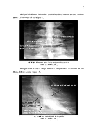21

Mielografia lombar em incidência AP com bloqueio do contraste por uma volumosa
Hérnia Discal lombar L4- L5 (Figura 9).

FIGURA 9 Lombar em AP com bloqueio do contraste.
Fonte: (SANTOS, 2012)
Mielografia em incidência oblíqua mostrando compressão da raiz nervosa por uma
Hérnia de Disco lombar (Figura 10).

FIGURA 10 Lombar perfil Mielografia
Fonte: (SANTOS, 2012)

 