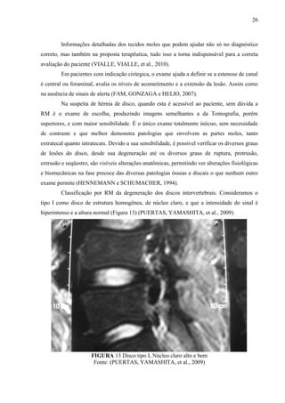 26

Informações detalhadas dos tecidos moles que podem ajudar não só no diagnóstico
correto, mas também na proposta terapêutica, tudo isso a torna indispensável para a correta
avaliação do paciente (VIALLE, VIALLE, et al., 2010).
Em pacientes com indicação cirúrgica, o exame ajuda a definir se a estenose de canal
é central ou foraminal, avalia os níveis de acometimento e a extensão da lesão. Assim como
na ausência de sinais de alerta (FAM, GONZAGA e HELIO, 2007).
Na suspeita de hérnia de disco, quando esta é acessível ao paciente, sem dúvida a
RM é o exame de escolha, produzindo imagens semelhantes a da Tomografia, porém
superiores, e com maior sensibilidade. É o único exame totalmente inócuo, sem necessidade
de contraste e que melhor demonstra patologias que envolvem as partes moles, tanto
extratecal quanto intratecais. Devido a sua sensibilidade, é possível verificar os diversos graus
de lesões do disco, desde sua degeneração até os diversos graus de ruptura, protrusão,
extrusão e seqüestro, são visíveis alterações anatômicas, permitindo ver alterações fisiológicas
e biomecânicas na fase precoce das diversas patologias ósseas e discais o que nenhum outro
exame permite (HENNEMANN e SCHUMACHER, 1994).
Classificação por RM da degeneração dos discos intervertebrais. Consideramos o
tipo I como disco de estrutura homogênea, de núcleo claro, e que a intensidade do sinal é
hiperintenso e a altura normal (Figura 13) (PUERTAS, YAMASHITA, et al., 2009).

FIGURA 13 Disco tipo I, Núcleo claro alto e bem
Fonte: (PUERTAS, YAMASHITA, et al., 2009)

 