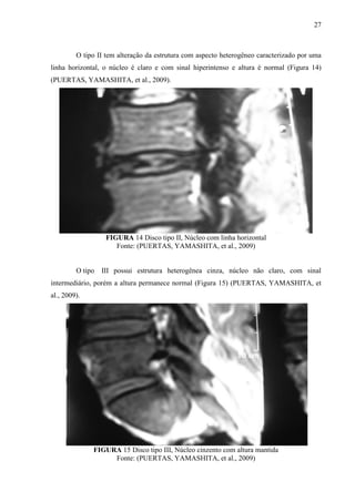 27

O tipo II tem alteração da estrutura com aspecto heterogêneo caracterizado por uma
linha horizontal, o núcleo é claro e com sinal hiperintenso e altura é normal (Figura 14)
(PUERTAS, YAMASHITA, et al., 2009).

FIGURA 14 Disco tipo II, Núcleo com linha horizontal
Fonte: (PUERTAS, YAMASHITA, et al., 2009)

O tipo

III possui estrutura heterogênea cinza, núcleo não claro, com sinal

intermediário, porém a altura permanece normal (Figura 15) (PUERTAS, YAMASHITA, et
al., 2009).

FIGURA 15 Disco tipo III, Núcleo cinzento com altura mantida
Fonte: (PUERTAS, YAMASHITA, et al., 2009)

 
