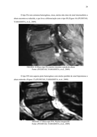 28

O tipo IVa tem estrutura heterogênea, cinza, núcleo não claro de sinal intermediário a
altura encontra-se reduzida, o que leva a diferenciação com o tipo III (Figura 16) (PUERTAS,
YAMASHITA, et al., 2009).

FIGURA 16 Disco tipo IVa núcleo cinzento e perda de altura
Fonte: (PUERTAS, YAMASHITA, et al., 2009)

O tipo IVb tem aspecto preto heterogêneo com núcleo perdido de sinal hipointenso e
altura reduzida. (Figura 17) (PUERTAS, YAMASHITA, et al., 2009)

FIGURA 17 Disco tipo IVb, Núcleo enegrecido
Fonte: (PUERTAS, YAMASHITA, et al., 2009)

 