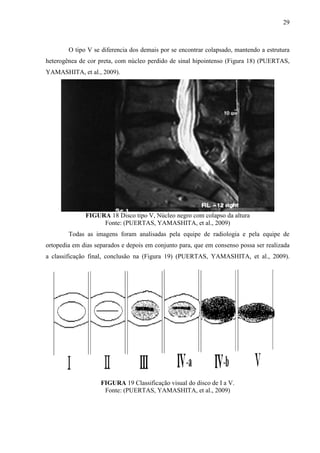 29

O tipo V se diferencia dos demais por se encontrar colapsado, mantendo a estrutura
heterogênea de cor preta, com núcleo perdido de sinal hipointenso (Figura 18) (PUERTAS,
YAMASHITA, et al., 2009).

FIGURA 18 Disco tipo V, Núcleo negro com colapso da altura
Fonte: (PUERTAS, YAMASHITA, et al., 2009)
Todas as imagens foram analisadas pela equipe de radiologia e pela equipe de
ortopedia em dias separados e depois em conjunto para, que em consenso possa ser realizada
a classificação final, conclusão na (Figura 19) (PUERTAS, YAMASHITA, et al., 2009).

FIGURA 19 Classificação visual do disco de I a V.
Fonte: (PUERTAS, YAMASHITA, et al., 2009)

 