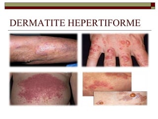 DERMATITE HEPERTIFORME

 