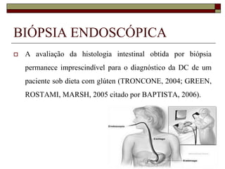 BIÓPSIA ENDOSCÓPICA


A avaliação da histologia intestinal obtida por biópsia
permanece imprescindível para o diagnóstico da DC de um
paciente sob dieta com glúten (TRONCONE, 2004; GREEN,
ROSTAMI, MARSH, 2005 citado por BAPTISTA, 2006).

 