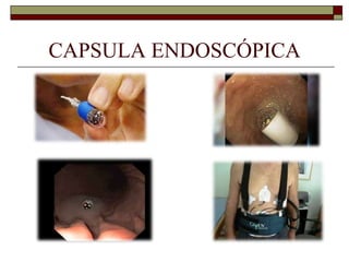 CAPSULA ENDOSCÓPICA

 