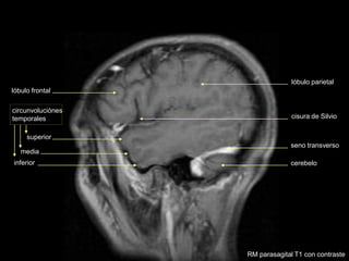 cisura de Silvio
superior
media
inferior
circunvoluciónes
temporales
cerebelo
seno transverso
lóbulo parietal
lóbulo frontal
RM parasagital T1 con contraste
 
