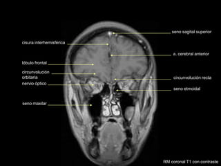 seno etmoidal
circunvolución recta
a. cerebral anterior
seno sagital superior
nervio óptico
seno maxilar
lóbulo frontal
circunvolución
orbitaria
cisura interhemisférica
RM coronal T1 con contraste
 