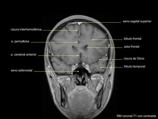 seno sagital superior
asta frontal
cisura de Silvio
lóbulo temporal
lóbulo frontal
cisura interhemisférica
a. pericallosa
a. cerebral anterior
seno esfenoidal
RM coronal T1 con contraste
 