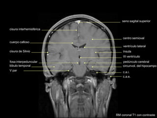 seno sagital superior
cisura de Silvio
lóbulo temporal
cisura interhemisférica
III ventrículo
cuerpo calloso
ventrículo lateral
centro semioval
fosa interpeduncular
ínsula
pedúnculo cerebral
V par
circunvol. del hipocampo
c.a.i.
c.a.e.
RM coronal T1 con contraste
 
