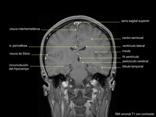 seno sagital superior
cisura de Silvio
lóbulo temporal
cisura interhemisférica
III ventrículo
ventrículo lateral
centro semioval
ínsula
pedúnculo cerebral
circunvolución
del hipocampo
a. pericallosa
RM coronal T1 con contraste
 