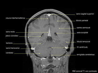 seno sagital superior
cisura interhemisférica
asta occipital
centro semioval
IV ventrículo
tentorio
cerebelo
amígdala cerebelosa
plexo coroideo
lóbulo parietal
lóbulo temporal
seno transverso
seno recto
RM coronal T1 con contraste
 