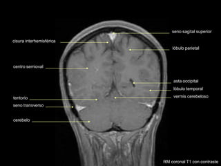 seno sagital superior
cisura interhemisférica
centro semioval
tentorio
cerebelo
lóbulo parietal
lóbulo temporal
seno transverso
vermis cerebeloso
RM coronal T1 con contraste
asta occipital
 