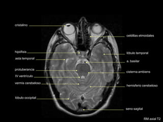 lóbulo occipital
hemisferio cerebeloso
lóbulo temporal
protuberancia
IV ventrículo
cisterna ambiens
asta temporal
a. basilar
hipófisis
vermis cerebeloso
seno sagital
RM axial T2
cristalino
celdillas etmoidales
 