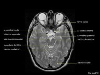 pedúnculo cerebral
nervio óptico
cisterna supraselar
cist. interpenduncular
acueducto de Silvio
vermis cerebeloso
lóbulo occipital
a. cerebral media a. carótida interna
RM axial T2
a. cerebral posterior
 
