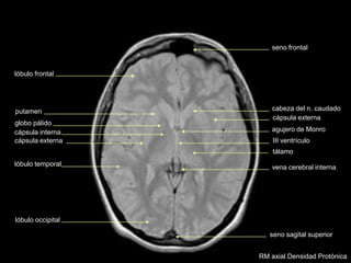 cabeza del n. caudado
III ventrículo
tálamo
lóbulo occipital
lóbulo temporal
cápsula externa
globo pálido
putamen
cápsula interna
seno sagital superior
lóbulo frontal
agujero de Monro
cápsula externa
vena cerebral interna
seno frontal
RM axial Densidad Protónica
 