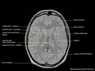 asta anterior
cuerpo del ventrículo
lateral
rodilla del c. calloso
cabeza del n. caudado
cisterna del
velo interpuesto
esplenium del c. calloso
núcleo lenticular
tálamo
cisura interhemisférica
seno sagital
lóbulo frontal
RM axial Densidad Protónica
 