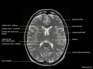 asta anterior
cuerpo del ventrículo
lateral
rodilla del c. calloso
cabeza del n. caudado
cisterna del
velo interpuesto
esplenium del c. calloso
núcleo lenticular
tálamo
cisura interhemisférica
seno sagital
lóbulo frontal
RM axial T2
 