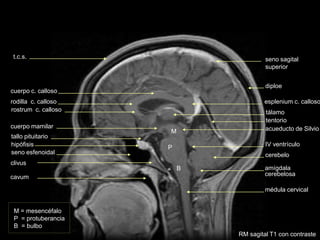 médula cervical
amígdala
cerebelosa
IV ventrículo
esplenium c. calloso
tálamo
cerebelo
M = mesencéfalo
P = protuberancia
B = bulbo
M
P
B
rostrum c. calloso
rodilla c. calloso
cuerpo c. calloso
clivus
seno esfenoidal
hipófisis
tallo pituitario
tentorio
seno sagital
superior
diploe
t.c.s.
acueducto de Silvio
RM sagital T1 con contraste
cuerpo mamilar
cavum
 