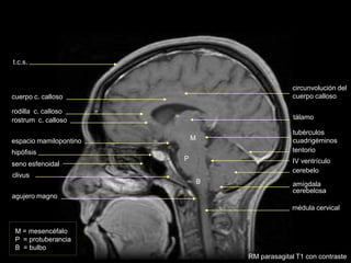 M = mesencéfalo
P = protuberancia
B = bulbo
M
P
B
médula cervical
amígdala
cerebelosa
IV ventrículo
tálamo
cerebelo
tentorio
tubérculos
cuadrigéminos
rostrum c. calloso
rodilla c. calloso
cuerpo c. calloso
clivus
seno esfenoidal
hipófisis
t.c.s.
espacio mamilopontino
circunvolución del
cuerpo calloso
agujero magno
RM parasagital T1 con contraste
 