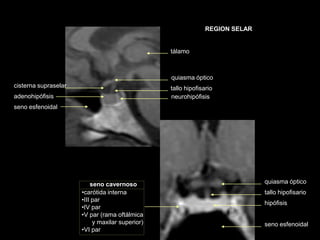 REGION SELAR
adenohipófisis neurohipófisis
seno esfenoidal
tallo hipofisario
quiasma óptico
tálamo
cisterna supraselar
seno cavernoso quiasma óptico
tallo hipofisario
hipófisis
seno esfenoidal
•carótida interna
•III par
•IV par
•V par (rama oftálmica
y maxilar superior)
•VI par
 