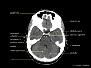 lóbulo temporal
t.c.s.
dorso selar
cerebelo
protuberancia
vermis cerebeloso
IV ventrículo
cisterna prepontina
a. basilar
lóbulo frontal
seno frontal
nódulo
pirámide petrosa
TC axial con contraste
 