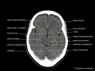 cisura interhemisférica
III ventrículo
plexo coroideo
lóbulo frontal
cisura de Silvio
ínsula
cisterna interpeduncular
pedúnculo cerebral
cisterna cuadrigeminal tubérculo cuadrigémino
cerebelo vermis cerebeloso
cabeza del n. caudado
TC axial con contraste
 
