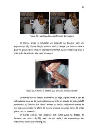 15




                  Figura 19. Verificando os parâmetros da imagem.


      O técnico prega o simulador de proteção na bandeja com um
esparadrapo (fig.20) na direção onde o médico deseja que fique e volta a
pisar no pedal para a imagem aparecer no monitor. Após o médico aprovar a
colocação da proteção, ele salva a imagem.




             Figura 20. Fixando o artefato que simula a proteção ocular.


      O técnico tira do campo assimétrico, ou seja, aquele onde o par de
colimadores move-se de modo independente entre si, através do botão ASYM
encontrado no Pendant. Ele “libera” a mesa no sentido longitudinal através de
um botão encontrado na lateral da mesa e encaixa no campo certo. Só então
põe a cruz do isocentro.
      O técnico põe as fitas adesivas com listras azuis na direção do
tamanho de campo (fig.21), além de um pedaço de esparadrapo liso
indicando a proteção ocular (fig.22).
 
