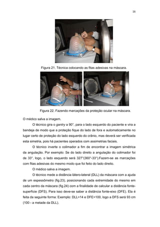 16




            Figura 21. Técnica colocando as fitas adesivas na máscara.




           Figura 22. Fazendo marcações da proteção ocular na máscara.

O médico salva a imagem.
      O técnico gira o gantry a 90°, para o lado esquerdo do paciente e vira a
bandeja de modo que a proteção fique do lado de fora e automaticamente no
lugar certo de proteção do lado esquerdo do crânio, mas deverá ser verificada
esta simetria, pois há pacientes operados com assimetrias faciais.
      O técnico inverte o colimador a fim de encontrar a imagem simétrica
da angulação. Por exemplo: Se do lado direito a angulação do colimador foi
de 33°, logo, o lado esquerdo será 327°(360°-33°).Fazem-se as marcações
com fitas adesivas do mesmo modo que foi feito do lado direito.
      O médico salva a imagem.
      O técnico mede a distância látero-lateral (DLL) da máscara com a ajuda
de um espessômetro (fig.23), posicionando cada extremidade do mesmo em
cada centro da máscara (fig.24) com a finalidade de calcular a distância fonte-
superfície (DFS). Para isso deve-se saber a distância fonte-eixo (DFE). Ela é
feita da seguinte forma: Exemplo: DLL=14 e DFE=100, logo a DFS será 93 cm
(100 - a metade da DLL).
 