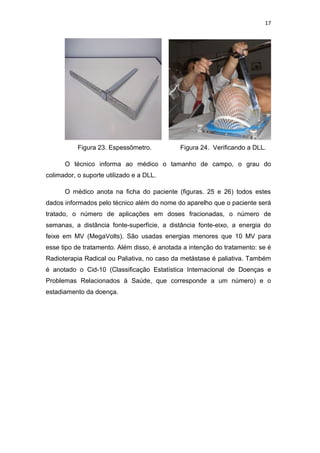 17




           Figura 23. Espessômetro.          Figura 24. Verificando a DLL.

      O técnico informa ao médico o tamanho de campo, o grau do
colimador, o suporte utilizado e a DLL.

      O médico anota na ficha do paciente (figuras. 25 e 26) todos estes
dados informados pelo técnico além do nome do aparelho que o paciente será
tratado, o número de aplicações em doses fracionadas, o número de
semanas, a distância fonte-superfície, a distância fonte-eixo, a energia do
feixe em MV (MegaVolts). São usadas energias menores que 10 MV para
esse tipo de tratamento. Além disso, é anotada a intenção do tratamento: se é
Radioterapia Radical ou Paliativa, no caso da metástase é paliativa. Também
é anotado o Cid-10 (Classificação Estatística Internacional de Doenças e
Problemas Relacionados à Saúde, que corresponde a um número) e o
estadiamento da doença.
 