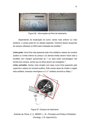 19




                   Figura 26. Informações da ficha de tratamento.


      Dependendo da localização do tumor, sendo mais anterior ou mais
posterior, o campo pode ter um desses aspectos. Veremos abaixo esquemas
de campos utilizados no INCA para irradiação de encéfalo: 6


Linha preta: Uma linha reta passando pela rima orbitária e abaixo do conduto
auditivo é o limite inferior do campo e os demais limites devem incluir todo o
encéfalo com margem aproximada de 1 cm para evitar sub-dosagem nas
bordas dos campos, sendo que os olhos devem ser protegidos. 6
Linha vermelha: Campo mais simples com base numa linha passando pelo
supercílio e abaixo do conduto auditivo. Este campo deixa de irradiar a região
retro-orbitária, recessos meníngeos e c1 (1° vértebra cervical ou Atlas). 6




                      Figura 27. Campos de tratamento

 Extraído de: Perez, C. A., BRADY, L. W., Principles and Pratice of Radiation
                         Oncology, J. B. Lippincott Co.
 