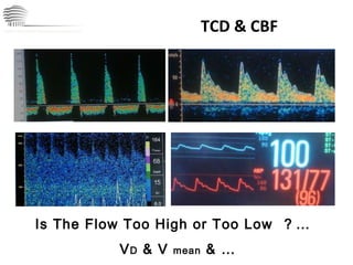 TCD & CBF CHINA International Neuroscience Institute ICU Is The Flow Too High or Too Low  ？…  V D  & V  mean  & … 