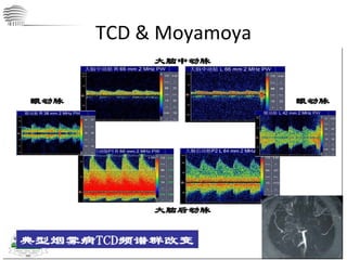 TCD & Moyamoya 