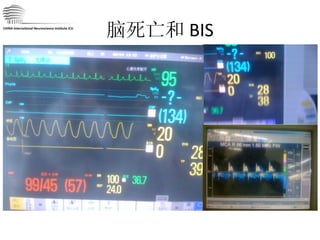 脑死亡和 BIS CHINA International Neuroscience Institute ICU 