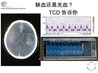 CHINA International Neuroscience Institute ICU 缺血还是充血？ TCD 告诉你 