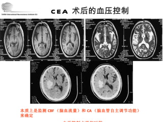 CHINA International Neuroscience Institute ICU CEA  术后的血压控制 本质上是监测 CBF （脑血流量）和 CA （脑血管自主调节功能）来确定 血压控制水平和时程 