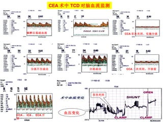 麻醉后基础血流 CCA 首次夹闭、实施分流   分流不全成功 分流成功 CCA 二次夹闭、开放前  CCA 、 ICA 、 ECA 开放  首次夹闭 血压变化 CEA 术中 TCD 对脑血流监测 