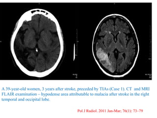 A 39-year-old women, 3 years after stroke, preceded by TIAs (Case 1). CT and MRI
FLAIR examination – hypodense area attributable to malacia after stroke in the right
temporal and occipital lobe.
Pol J Radiol. 2011 Jan-Mar; 76(1): 73–79
 