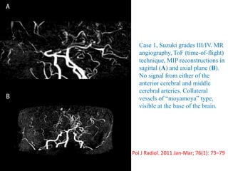 Pol J Radiol. 2011 Jan-Mar; 76(1): 73–79
Case 1, Suzuki grades III/IV. MR
angiography, ToF (time-of-flight)
technique, MIP reconstructions in
sagittal (A) and axial plane (B).
No signal from either of the
anterior cerebral and middle
cerebral arteries. Collateral
vessels of “moyamoya” type,
visible at the base of the brain.
 