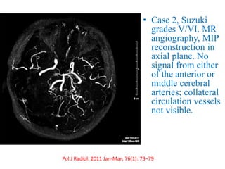 • Case 2, Suzuki
grades V/VI. MR
angiography, MIP
reconstruction in
axial plane. No
signal from either
of the anterior or
middle cerebral
arteries; collateral
circulation vessels
not visible.
Pol J Radiol. 2011 Jan-Mar; 76(1): 73–79
 