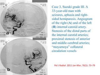 Case 3, Suzuki grade III. A
33-year-old man with
seizures, aphasia and right-
sided hemiparesis. Angiogram
of the right (A) and of the left
(B) internal carotid artery.
Stenosis of the distal parts of
the internal carotid arteries;
proximal stenosis of anterior
and middle cerebral arteries;
“moyamoya” collateral
circulation vessels
Pol J Radiol. 2011 Jan-Mar; 76(1): 73–79
 