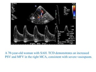 A 70-year-old woman with SAH. TCD demonstrates an increased
PSV and MFV in the right MCA, consistent with severe vasospasm.
 