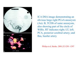 ICA DSA image demonstrating an
obvious large right PCoA aneurysm
(An). B, TCDS of same aneurysm,
also showing part of the circle of
Willis. RT indicates right; LT, left;
PCA, posterior cerebral artery; and
Bas, basilar artery
Philip et al, Stroke. 2001;32:1291–1297
 