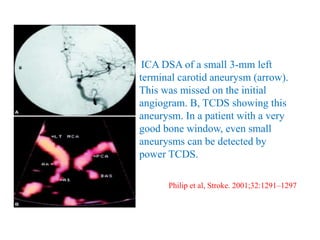 ICA DSA of a small 3-mm left
terminal carotid aneurysm (arrow).
This was missed on the initial
angiogram. B, TCDS showing this
aneurysm. In a patient with a very
good bone window, even small
aneurysms can be detected by
power TCDS.
Philip et al, Stroke. 2001;32:1291–1297
 