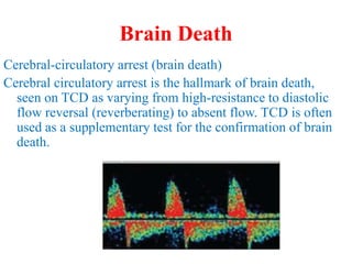 Brain Death
Cerebral-circulatory arrest (brain death)
Cerebral circulatory arrest is the hallmark of brain death,
seen on TCD as varying from high-resistance to diastolic
flow reversal (reverberating) to absent flow. TCD is often
used as a supplementary test for the confirmation of brain
death.
 