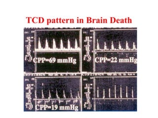 TCD pattern in Brain Death
 