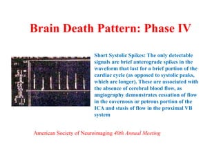 Brain Death Pattern: Phase IV
Short Systolic Spikes: The only detectable
signals are brief anterograde spikes in the
waveform that last for a brief portion of the
cardiac cycle (as opposed to systolic peaks,
which are longer). These are associated with
the absence of cerebral blood flow, as
angiography demonstrates cessation of flow
in the cavernous or petrous portion of the
ICA and stasis of flow in the proximal VB
system
American Society of Neuroimaging 40th Annual Meeting
 