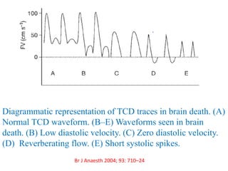 Diagrammatic representation of TCD traces in brain death. (A)
Normal TCD waveform. (B–E) Waveforms seen in brain
death. (B) Low diastolic velocity. (C) Zero diastolic velocity.
(D) Reverberating flow. (E) Short systolic spikes.
Br J Anaesth 2004; 93: 710–24
 