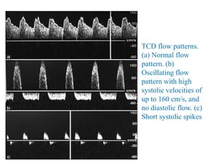TCD flow patterns.
(a) Normal flow
pattern. (b)
Oscillating flow
pattern with high
systolic velocities of
up to 160 cm/s, and
no diastolic flow. (c)
Short systolic spikes
 